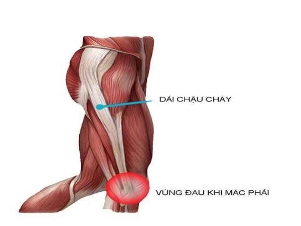 Hội chứng đau dải chậu chày (Iliotibial Band Syndrome)