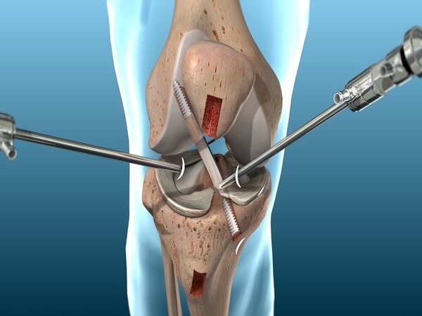 Rách dây chằng chéo trước (ACL)