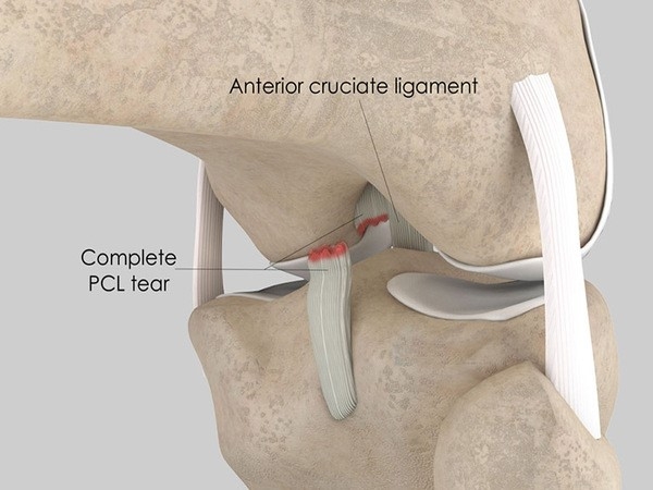 Rách dây chằng chéo sau (PCL)