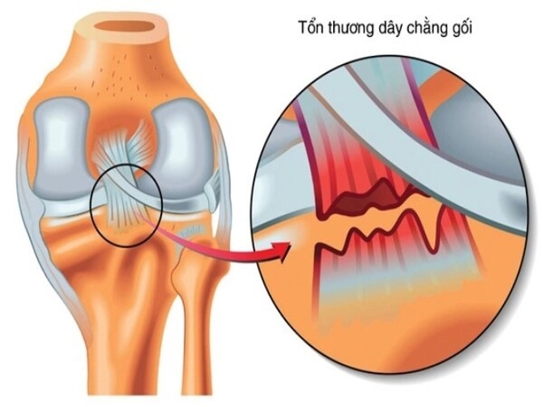 Chấn thương dây chằng bên ngoài (LCL)