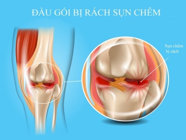 Chấn thương sụn chêm (Meniscus)