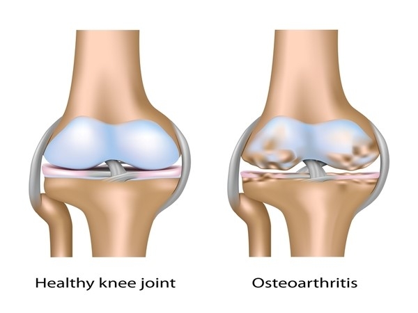 Viêm xương khớp đầu gối (Knee Osteoarthritis)