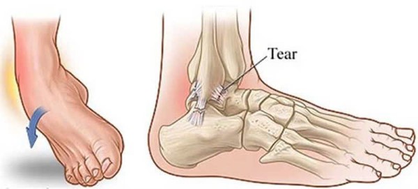 Chấn thương lật cổ chân là gì?